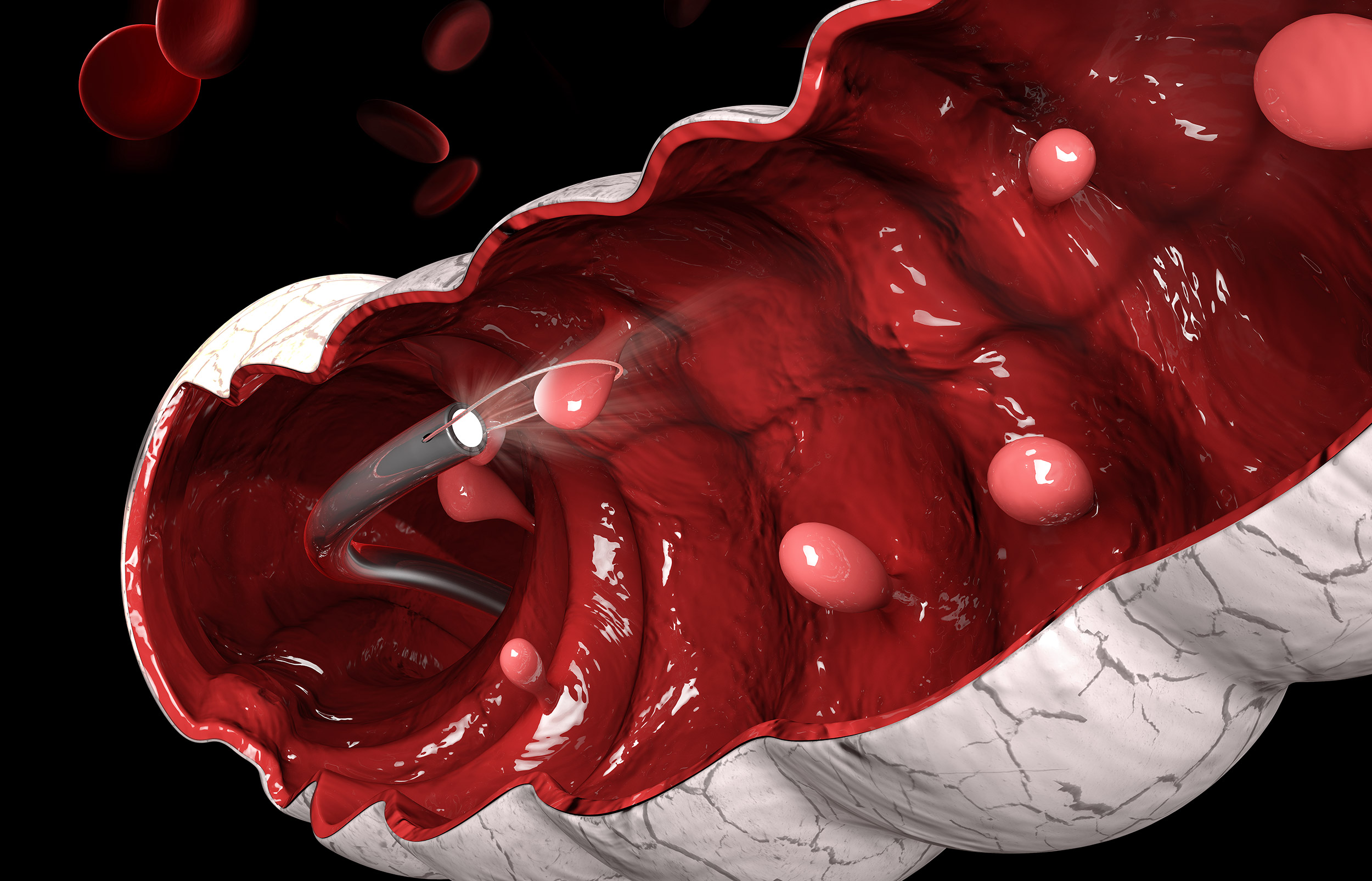 3d illustration of Removal of a colonic polyp with a electrical wire loop during a colonoscopy